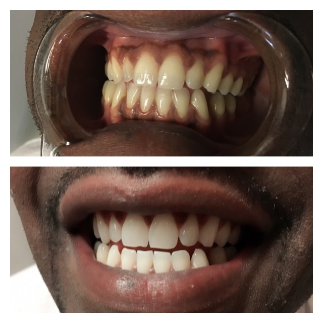 Professional Teeth Whitening • $125 • Home Care Kit Included